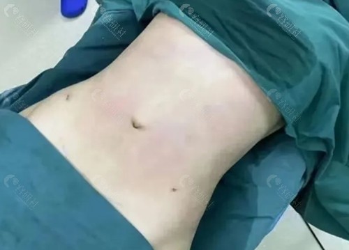 腰腹部吸脂哪家好