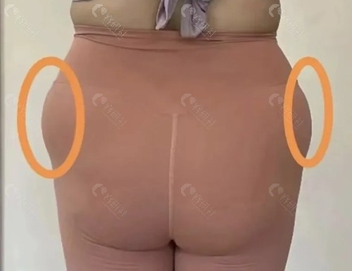 妈妈臀抽脂价格表
