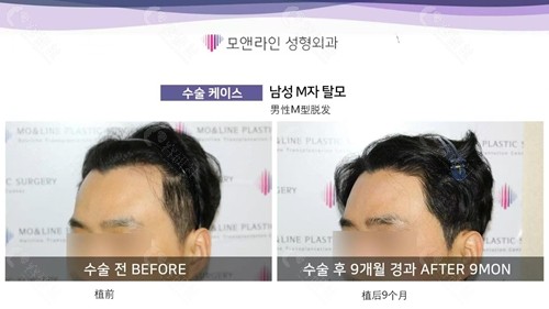 韩国毛莱茵男性发际线矫正9个月前后对比图