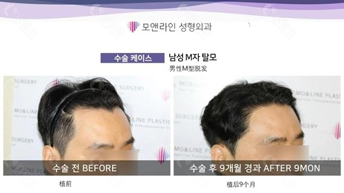 韩国毛莱茵男性发际线矫正9个月前后对比照