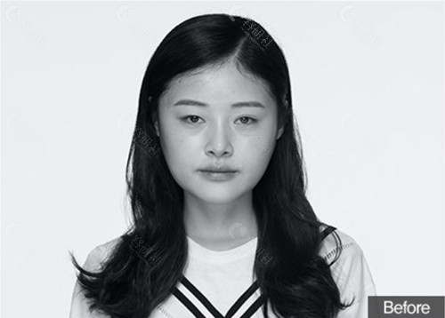韩国梦想整形外科医院眼鼻综合整形+激光溶脂提升术前