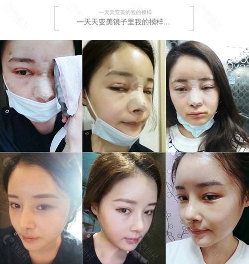 韩国梦想女孩清纯女神李淑雅手术恢复过程