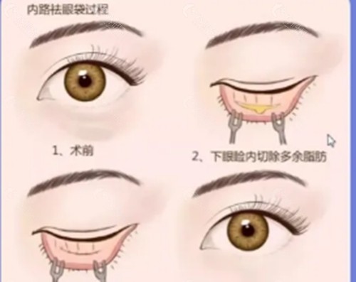 吴培海医生去眼袋怎么样