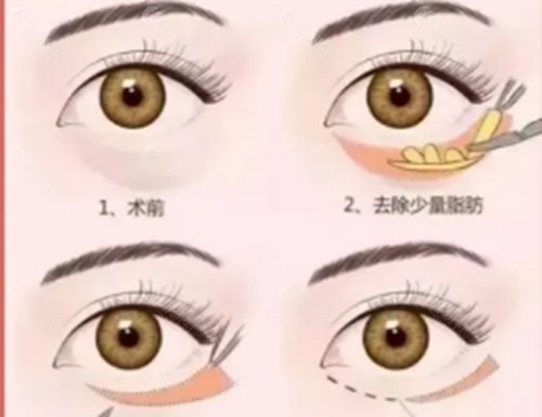 韩永强医生去眼袋好吗