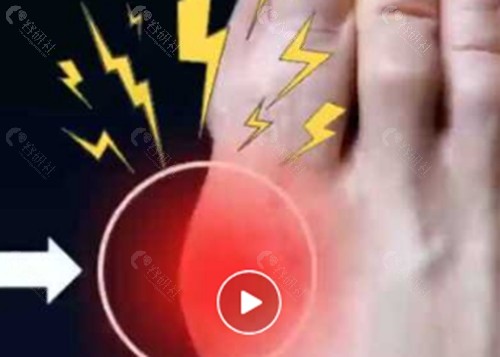 苏敬达医生做拇外翻手术好吗 苏敬达医生做拇外翻手术好吗