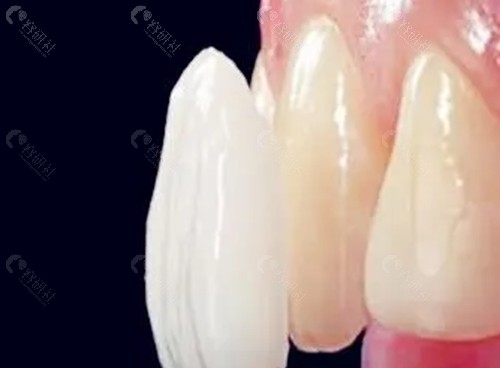 门牙做牙冠好还是贴面好