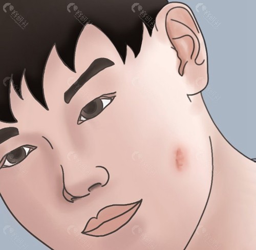  激光疤痕修复的疗程安排