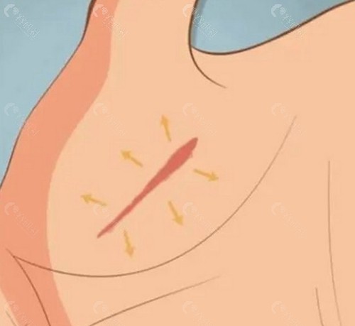 银川市激光疤痕修复的收费价格