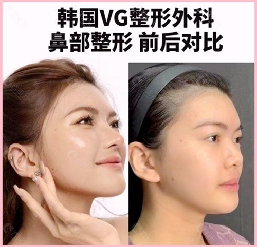 韩国VG百利酷整形外科鼻部整形前后对比图