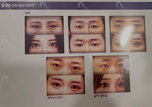 韩国I Contact整形外科双眼皮修复前后对比照
