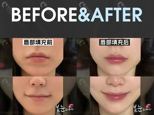 韩国纯整形医院瑞兰玻尿酸丰唇前后对比图