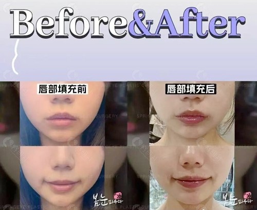 韩国纯整形医院瑞蓝玻尿酸丰唇图片