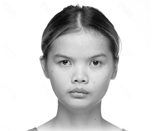 韩国梦想整形医院手术前的泰国女孩PRAPAPORN