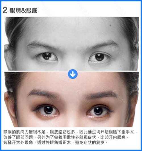 韩国梦想整形外科医院双眼皮手术前后对比照