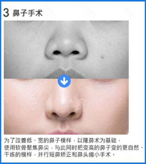 韩国梦想整形外科医院鼻子手术前后对比照