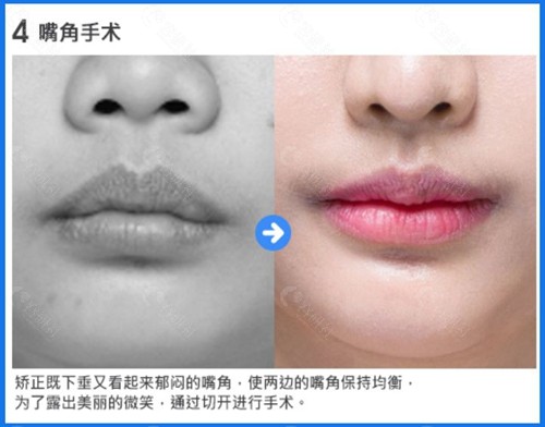 韩国梦想整形外科医院嘴角手术前后对比照