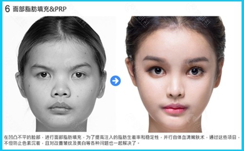 韩国梦想整形外科医院面部脂肪填充前后对比照