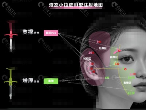 液态拉皮手术能维持多久？