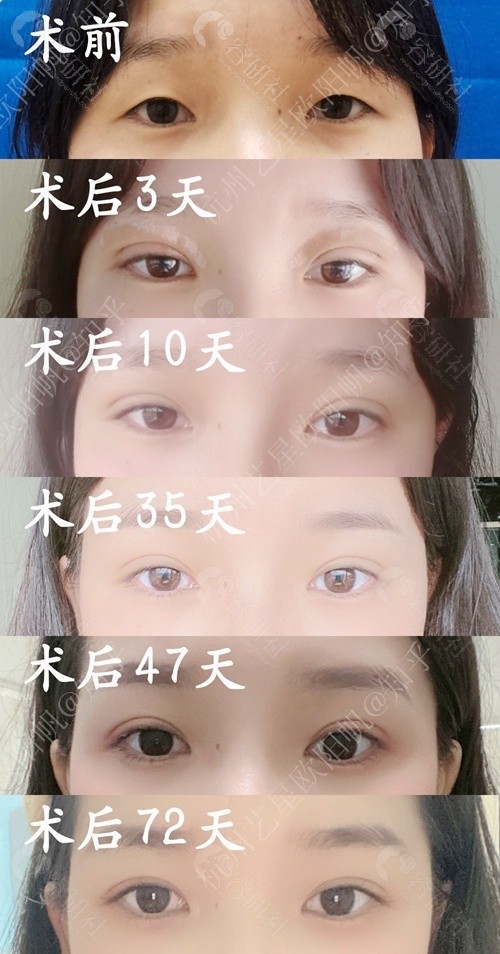 杭州艺星欧阳帆医生双眼皮手术恢复全过程
