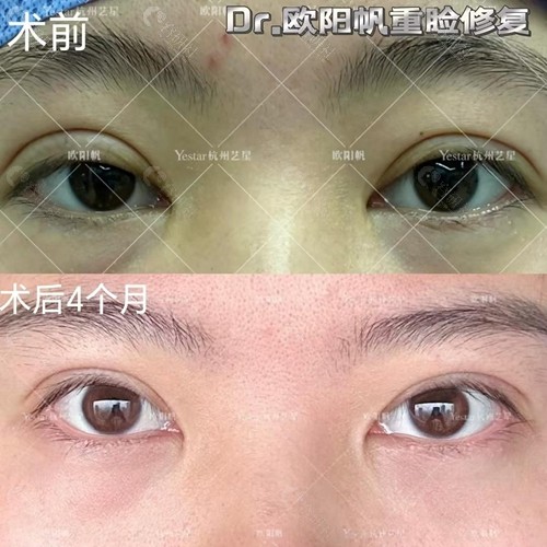 杭州艺星欧阳帆医生重睑修复术前和术后4个月