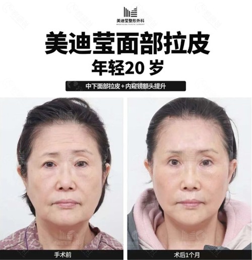 韩国美迪莹面部拉皮手术对比照