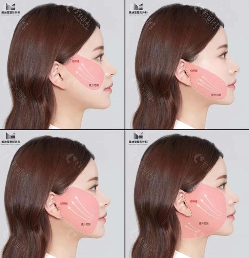韩国美迪莹面部拉皮手术过程