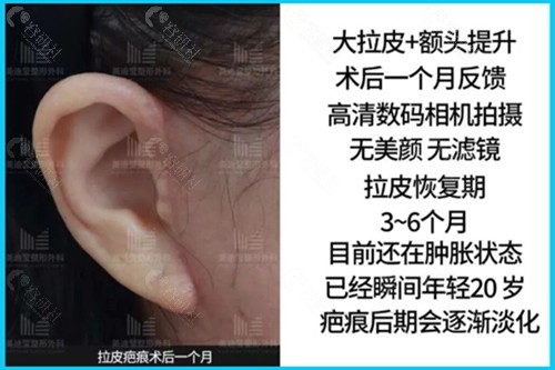 韩国美迪莹面部拉皮疤痕术后1个月