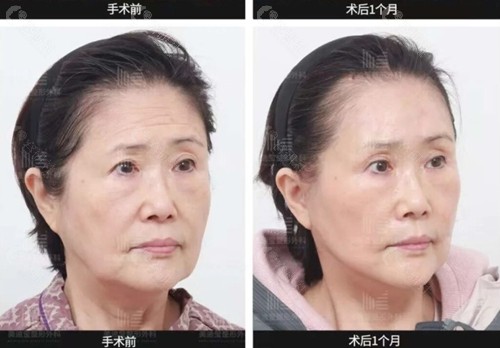 韩国美迪莹面部拉皮手术前后图片