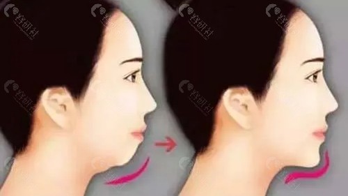 成人下巴后缩矫正方法有哪些