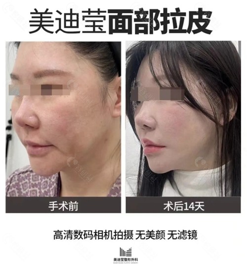 韩国美迪莹整形外科医院面部拉皮手术图片