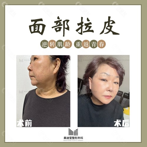 韩国美迪莹面部拉皮手术前后对比照