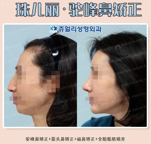 韩国珠儿丽驼峰鼻矫正+箭头鼻矫正+福鼻矫正+全脸脂肪填充前后对比照侧面