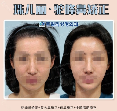 韩国珠儿丽驼峰鼻矫正+箭头鼻矫正+福鼻矫正+全脸脂肪填充前后对比照