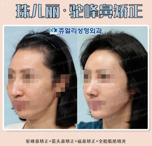 韩国珠儿丽驼峰鼻矫正+箭头鼻矫正+福鼻矫正+全脸脂肪填充术前术后对比照