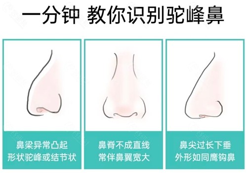 驼峰鼻怎么自然矫正？