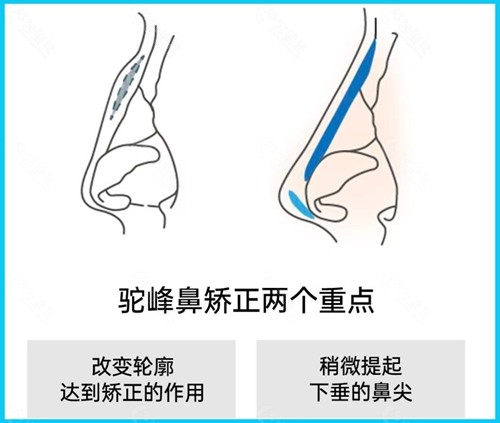 驼峰鼻怎么改善？