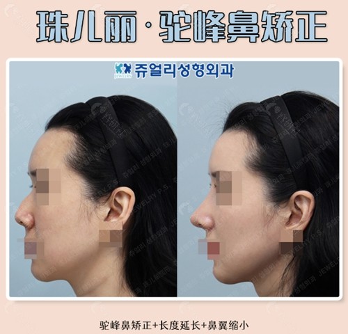 韩国珠儿丽驼峰鼻矫正+长度延长+鼻翼缩小前后对比照