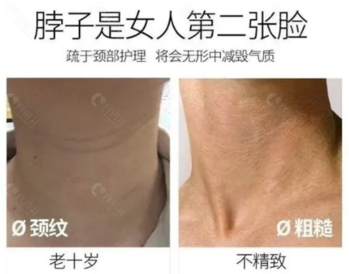 颈纹很深怎么办如何消除颈纹？