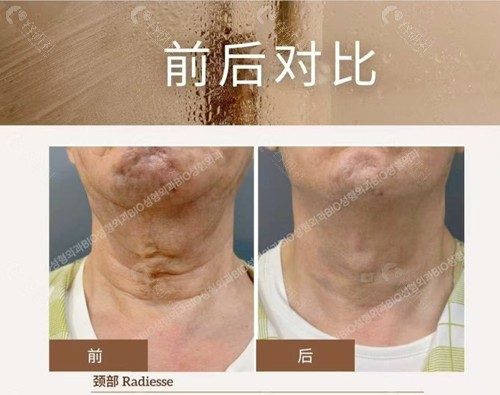韩国BIO整形医院俞惠美院长颈纹填充前后对比图