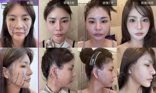 韩国必妩整形医院中面部大拉皮+颈部拉皮手术恢复过程图