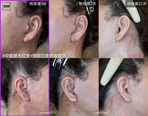 韩国必妩整形医院中面部大拉皮+颈部拉皮手术疤痕变化图