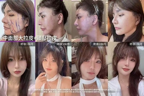 韩国必妩整形医院中面部大拉皮+颈部拉皮手术前后对比照