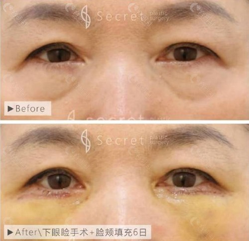 韩国希克丽下眼睑手术和脸颊填充术前和术后6日对比照