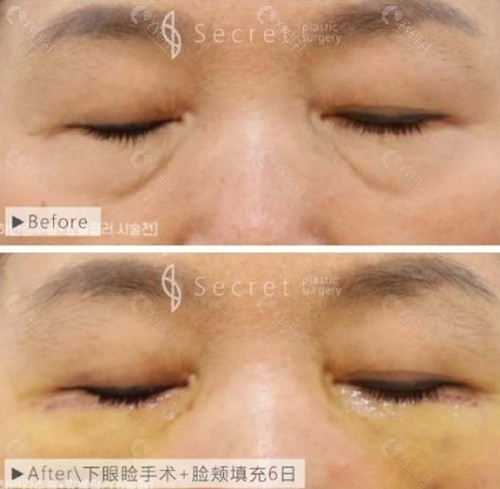 韩国希克丽下眼睑手术和脸颊填充术前和术后6天对比照