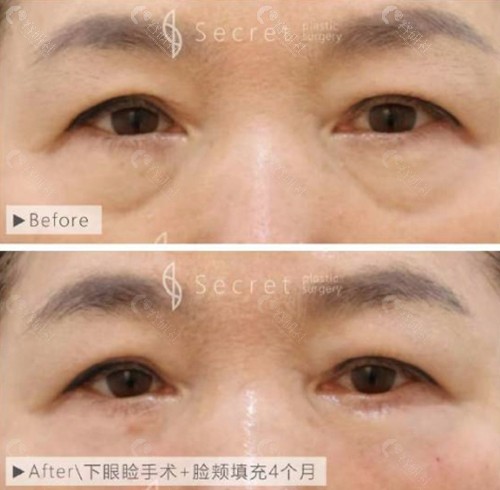 韩国希克丽下眼睑手术和脸颊填充术前和术后4个月对比照