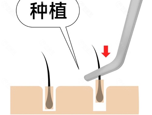 襄阳韩蔻植发好吗
