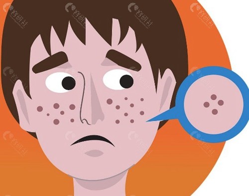 ADM人工真皮填充痘坑费用大概是多少？