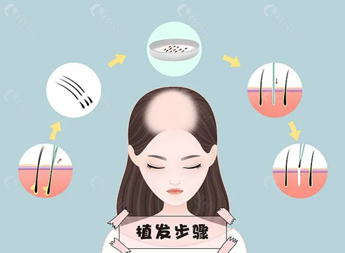 不剃发植发原理