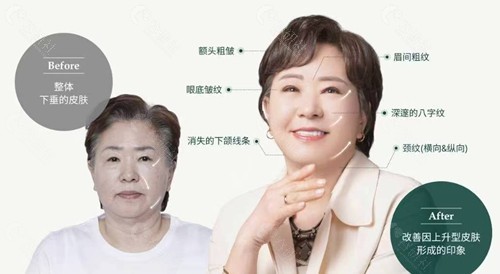 韩国丽婷医院面部提升优势