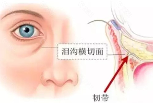 玻尿酸填充泪沟哪种成效好